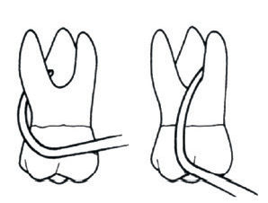 LM Furcation Probe 